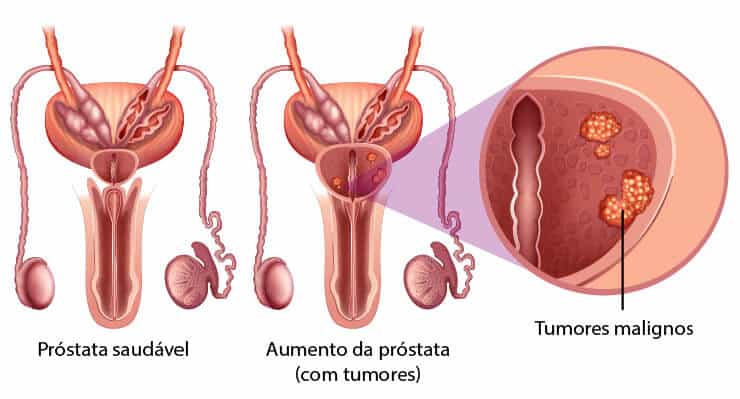 prostata 
