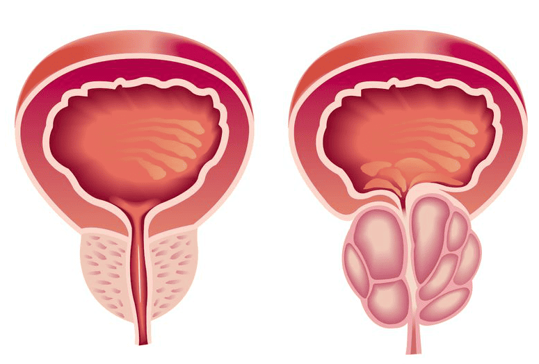Próstata Saudável e não saudável 