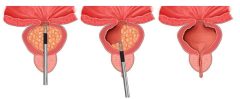 cirurgia robótica resseccao prostata