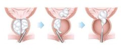 dr eliney faria urologista cirurgia robotica holep hiperplasia prostatica benigna