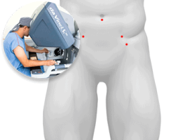 incisao-cirurgia-robotica-prostata